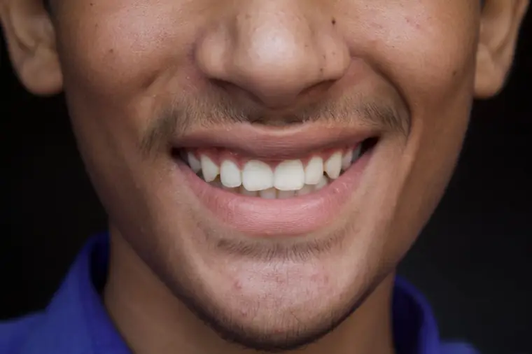 Close de um sorriso saudável depois do tratamento odontológico